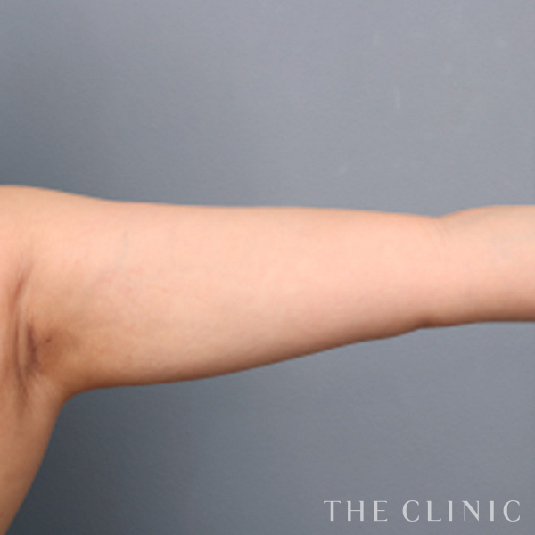 二の腕のベイザー脂肪吸引（34歳女性）の術後写真