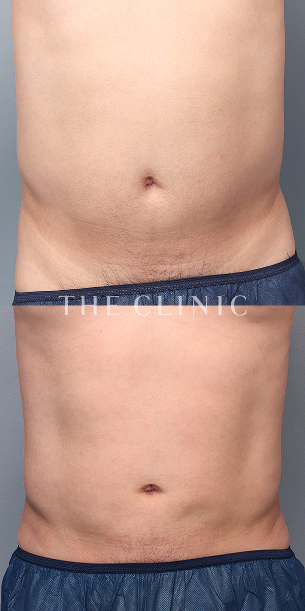 腹部のベイザー脂肪吸引（36歳男性）の術前・術後写真