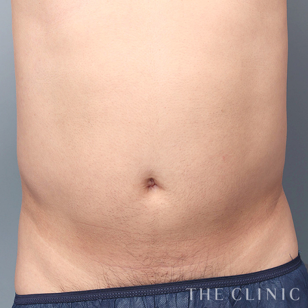 腹部のベイザー脂肪吸引（36歳男性）の術前写真