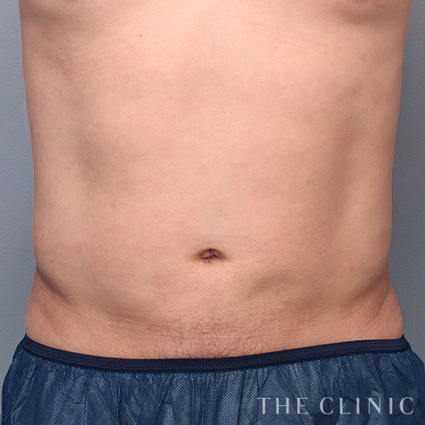 腹部のベイザー脂肪吸引（36歳男性）の術後写真