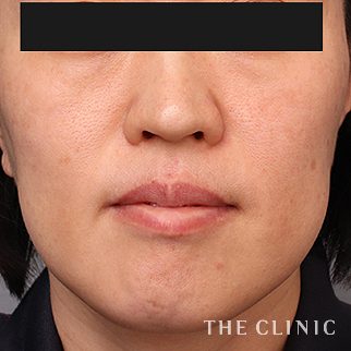 【THE CLINIC 症例画像】No.1458_1_こけた頬_VOVリフト(ボブリフト・プレミアム)(執刀医:村田 八千穂)