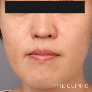 【THE CLINIC 症例画像】No.1458_2_こけた頬_VOVリフト(ボブリフト・プレミアム)(執刀医:村田 八千穂)