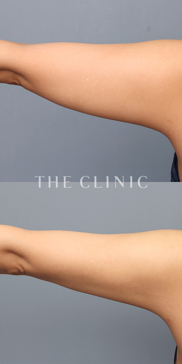 二の腕のベイザー脂肪吸引（39歳女性）の術前・術後写真