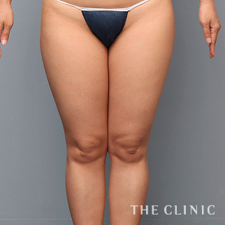 【THE CLINIC 症例画像】No.1460_1_太もも_ベイザー脂肪吸引(執刀医:村田 八千穂)