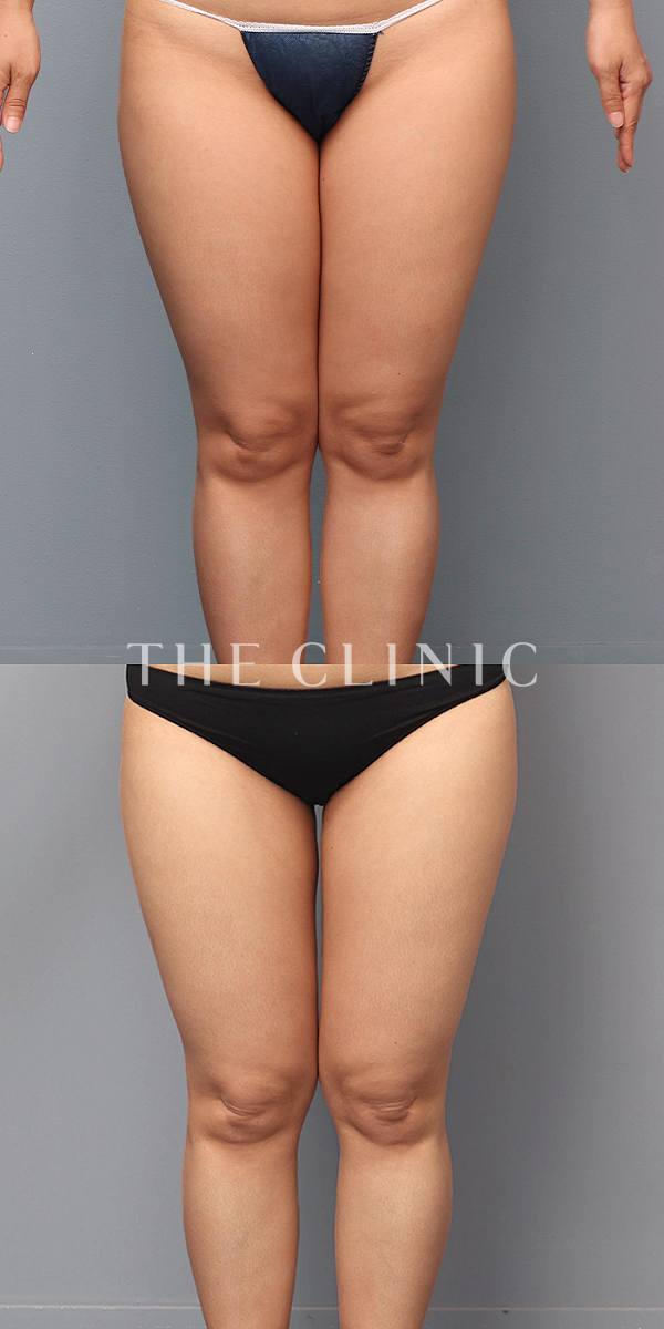 太もものベイザー脂肪吸引（39歳女性）の術前・術後写真