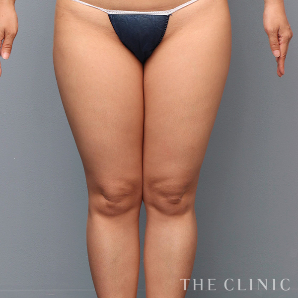 太もものベイザー脂肪吸引（39歳女性）の術前写真