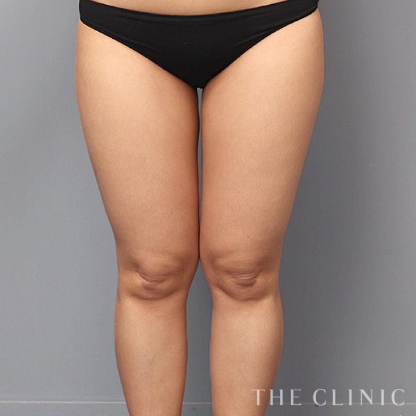 太もものベイザー脂肪吸引（39歳女性）の術後写真