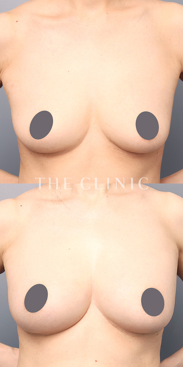 ボリュームアップのコンデンスリッチ豊胸（48歳女性）の術前・術後写真