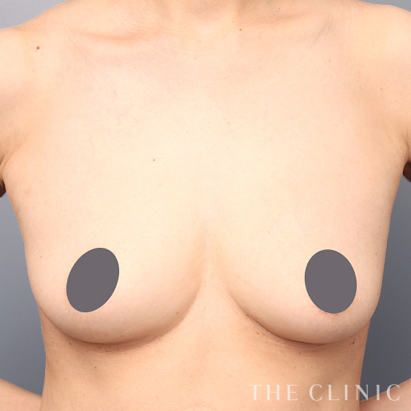 ボリュームアップのコンデンスリッチ豊胸（48歳女性）の術前写真