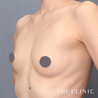 【THE CLINIC 症例画像】No.1463_1_ボリュームアップ_エクソソーム豊胸(執刀医:安部 光洋)