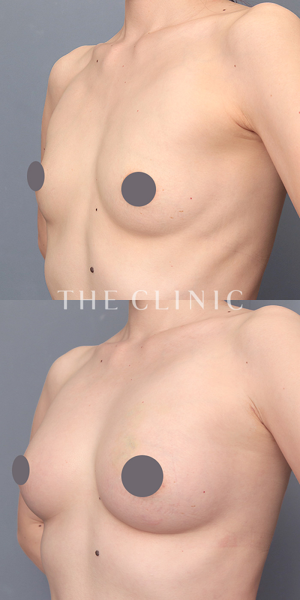 ボリュームアップのエクソソーム豊胸（32歳女性）の術前・術後写真