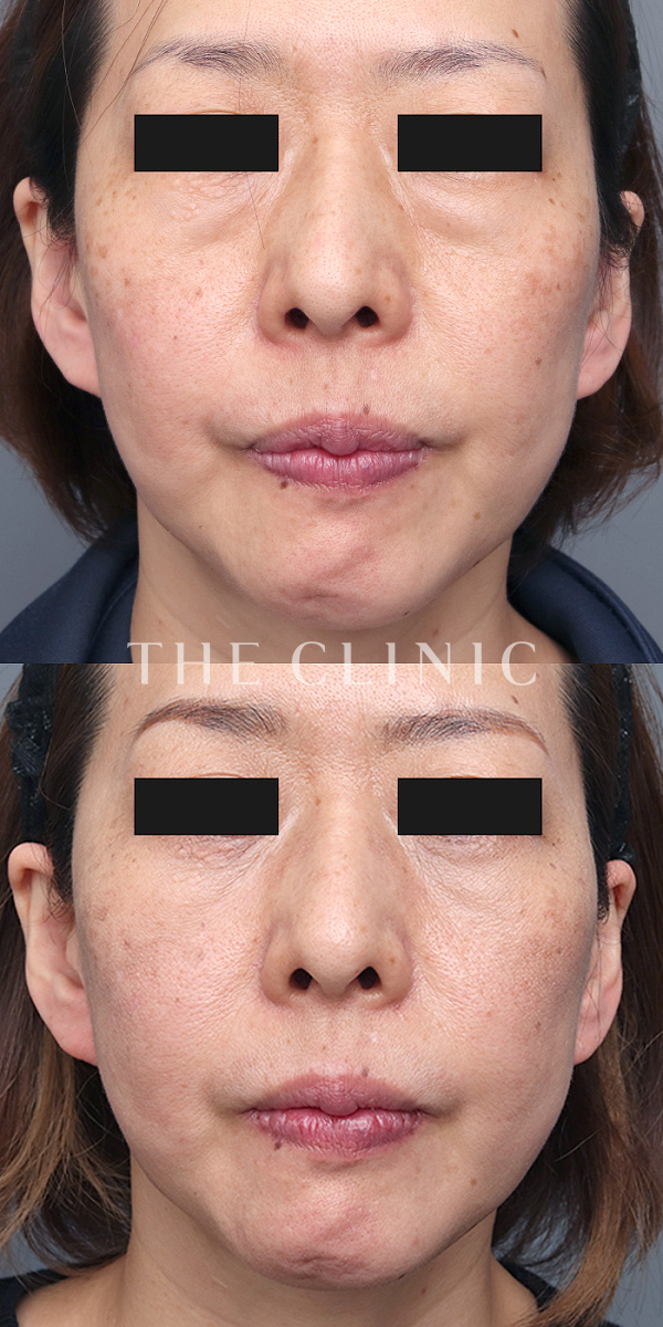 目の下のクマのマイクロCRF注入(顔の脂肪注入)（47歳女性）の術前・術後写真