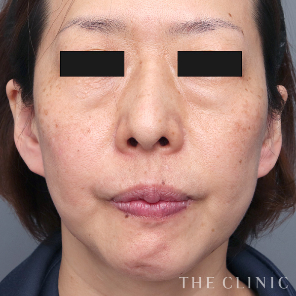 目の下のクマのマイクロCRF注入(顔の脂肪注入)（47歳女性）の術前写真