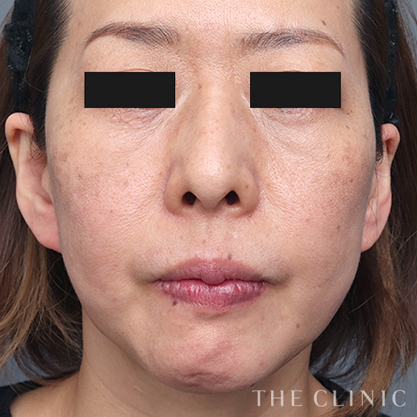 目の下のクマのマイクロCRF注入(顔の脂肪注入)（47歳女性）の術後写真