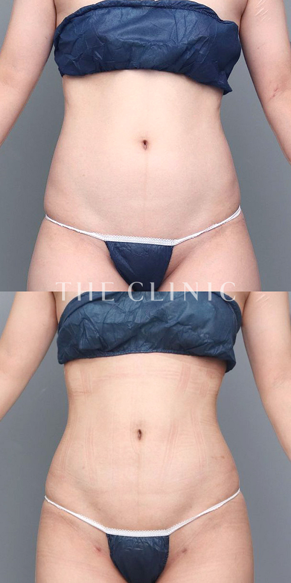 腹部のベイザー脂肪吸引（28歳女性）の術前・術後写真