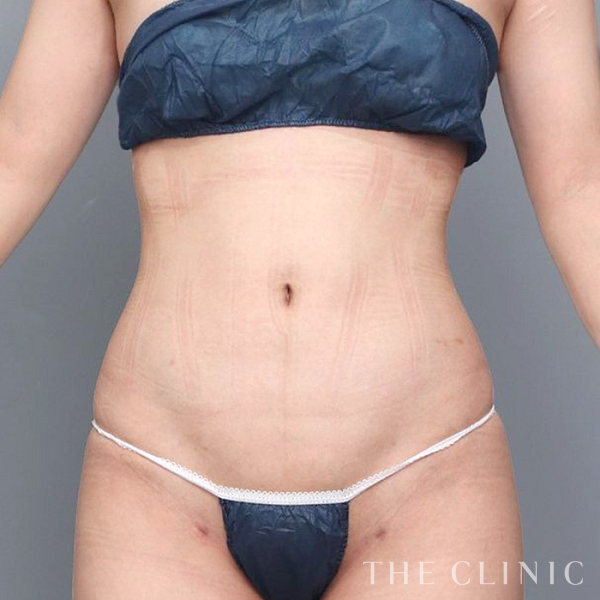 腹部のベイザー脂肪吸引（28歳女性）の術後写真