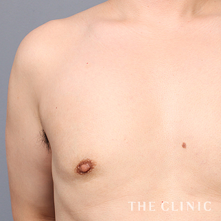 【THE CLINIC 症例画像】No.1467_2_偽性女性化乳房_女性化乳房治療(男性の胸の膨らみ改善)(執刀医:大橋 昌敬)