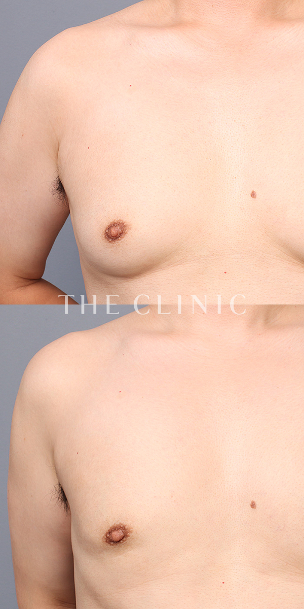 偽性女性化乳房の女性化乳房治療(男性の胸の膨らみ改善)（33歳男性）の術前・術後写真