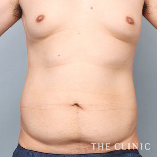 【THE CLINIC 症例画像】No.1468_1_胸部のデザイン_4D脂肪吸引(4Dリポ)(執刀医：大橋 昌敬)