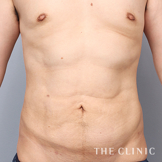 【THE CLINIC 症例画像】No.1468_2_胸部のデザイン_4D脂肪吸引(4Dリポ)(執刀医:大橋 昌敬)