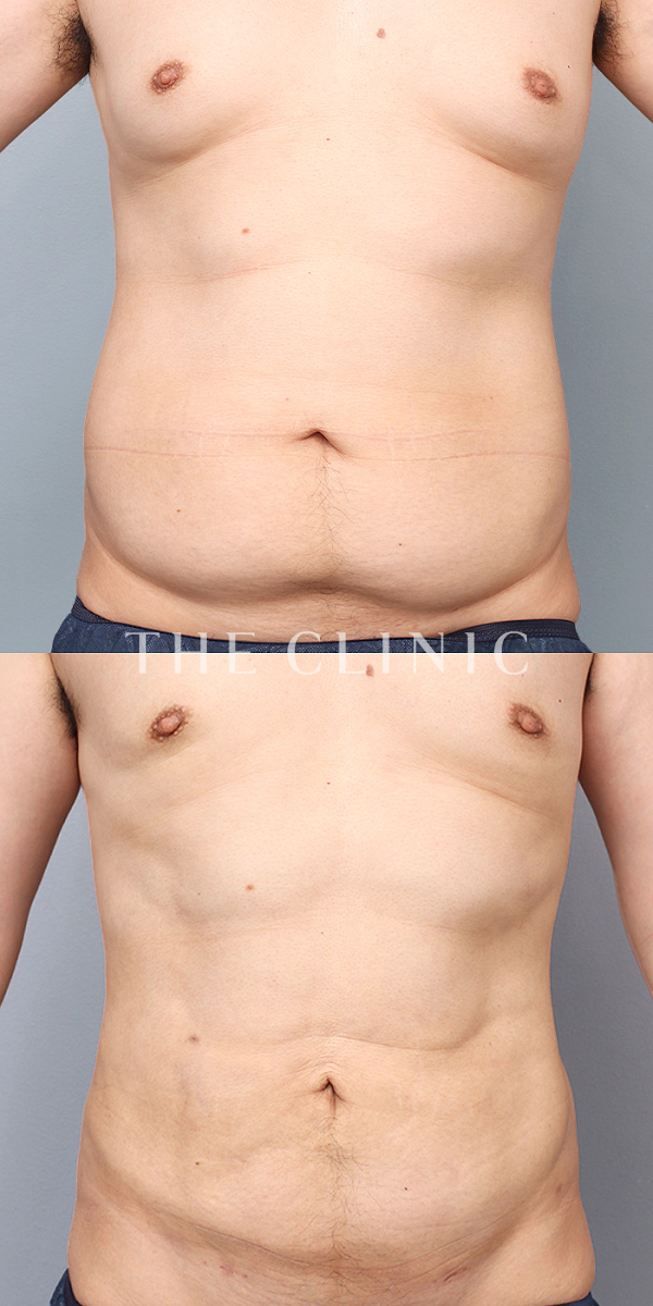 胸部のデザイン・SIX PACK ６つに割れた腹筋の4D脂肪吸引(4Dリポ)（33歳男性）の術前・術後写真