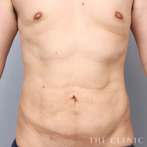胸部のデザイン・SIX PACK ６つに割れた腹筋の4D脂肪吸引(4Dリポ)（33歳男性）の術後写真
