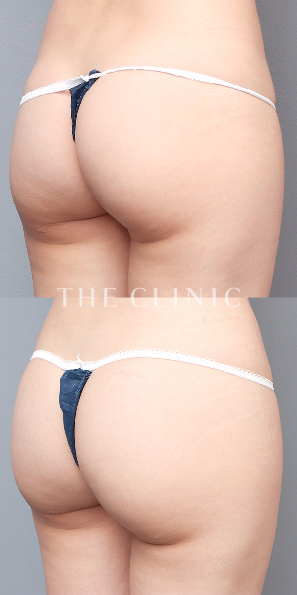 ボリュームアップの4D脂肪吸引(4Dリポ)（30歳女性）の術前・術後写真