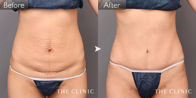 脂肪吸引 腹部 症例写真