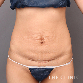 【THE CLINIC 症例画像】No.1472_1_腹部_タミータック4D(お腹のたるみ解消)(執刀医:今西 理也)