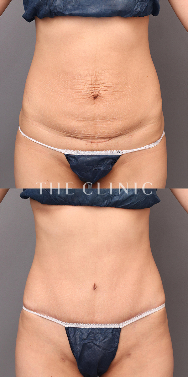 腹部のタミータック4D(お腹のたるみ解消)（34歳女性）の術前・術後写真