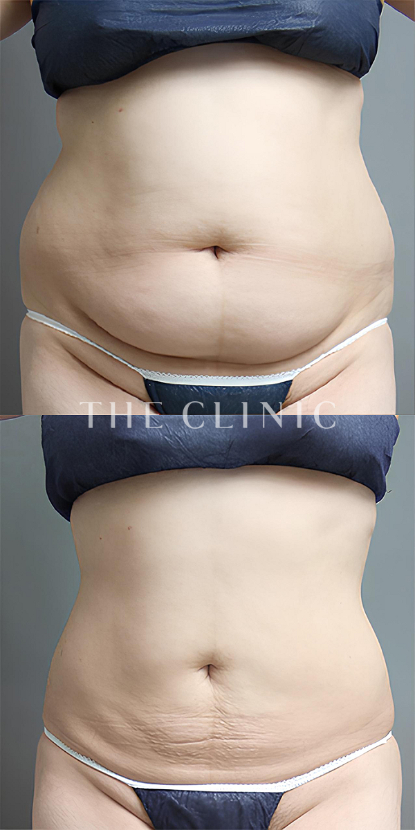 腹部のベイザー脂肪吸引（34歳女性）の術前・術後写真