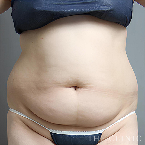 腹部のベイザー脂肪吸引（34歳女性）の術前写真