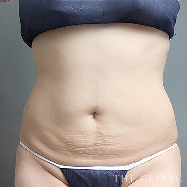 腹部のベイザー脂肪吸引（34歳女性）の術後写真