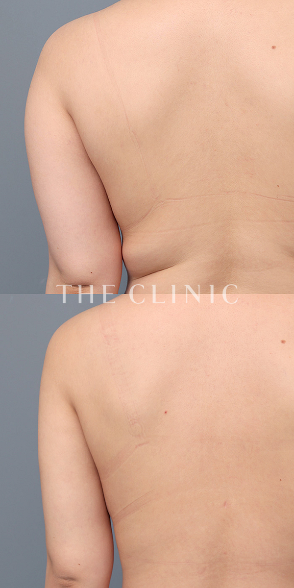 二の腕のベイザー脂肪吸引（21歳女性）の術前・術後写真