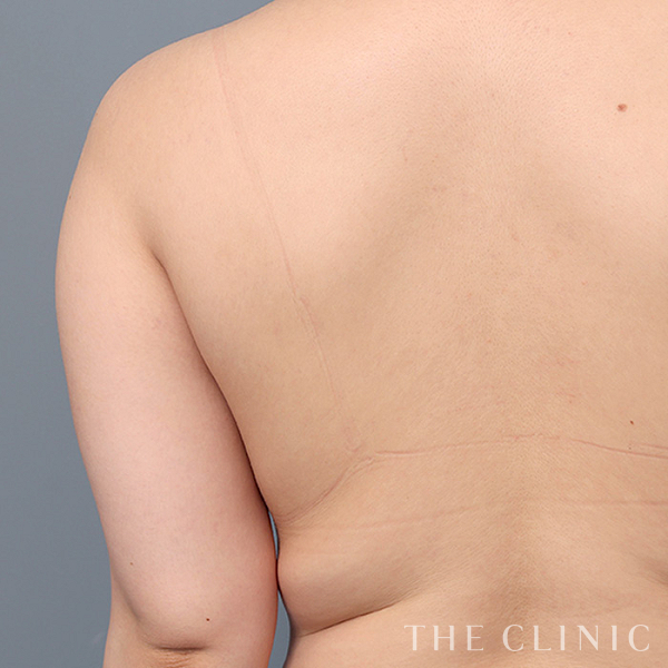 二の腕のベイザー脂肪吸引（21歳女性）の術前写真