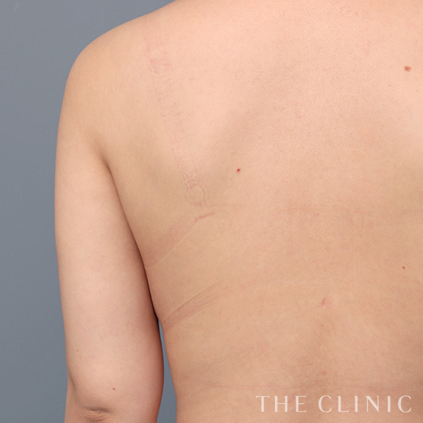 二の腕のベイザー脂肪吸引（21歳女性）の術後写真