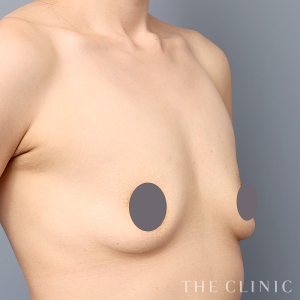 ボリュームアップのコンデンスリッチ豊胸（33歳女性）の術前写真