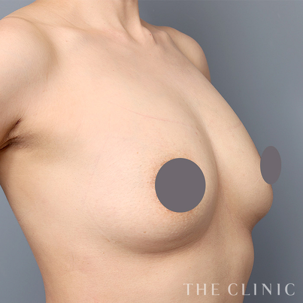 ボリュームアップのコンデンスリッチ豊胸（33歳女性）の術後写真