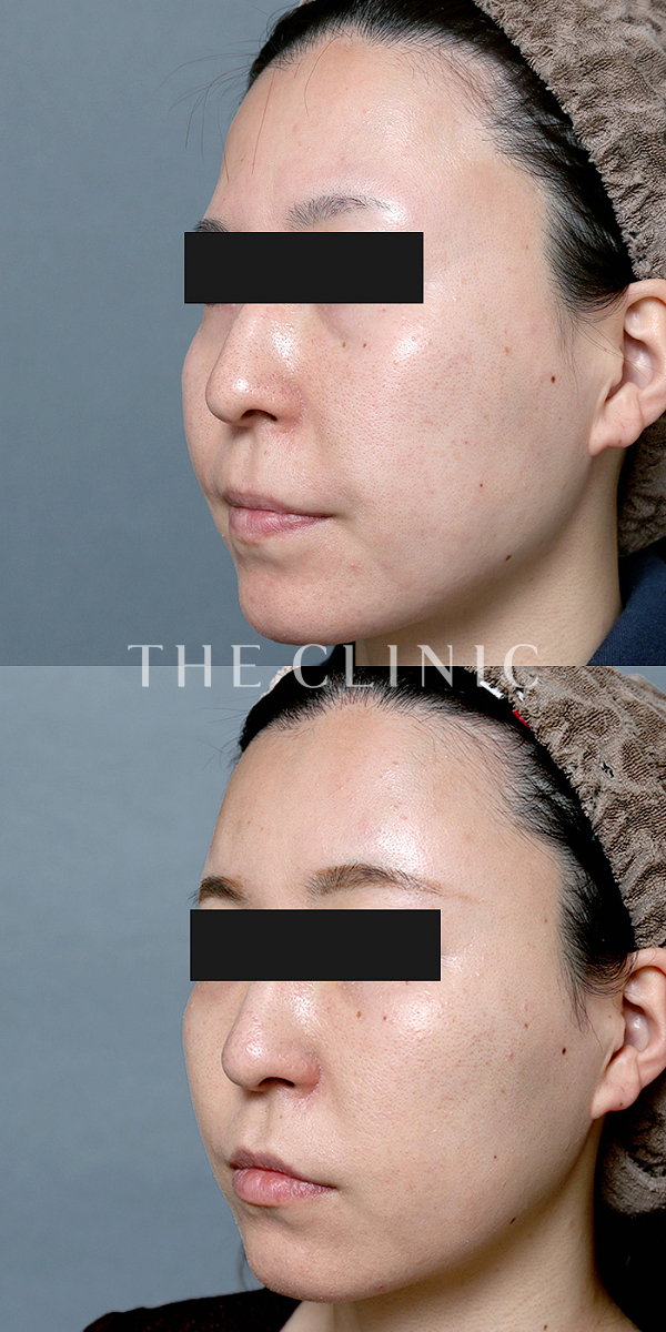 目の下のクマ・おでこ(額)のくぼみのマイクロCRF注入(顔の脂肪注入)（30歳女性）の術前・術後写真