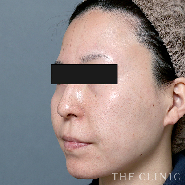 目の下のクマ・おでこ(額)のくぼみのマイクロCRF注入(顔の脂肪注入)（30歳女性）の術前写真