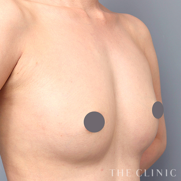 ボリュームアップのコンデンスリッチ豊胸（28歳女性）の術後写真