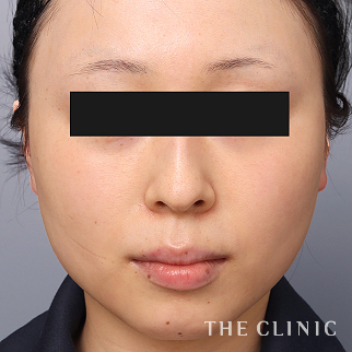 【THE CLINIC 症例画像】No.1478_1_頰/顎_360脂肪吸引®(執刀医:志田 雅明)