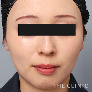 【THE CLINIC 症例画像】No.1478_2_頰/顎_360脂肪吸引®(執刀医:志田 雅明)