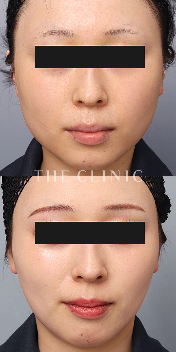 頰／顎のベイザー脂肪吸引（25歳女性）の術前・術後写真