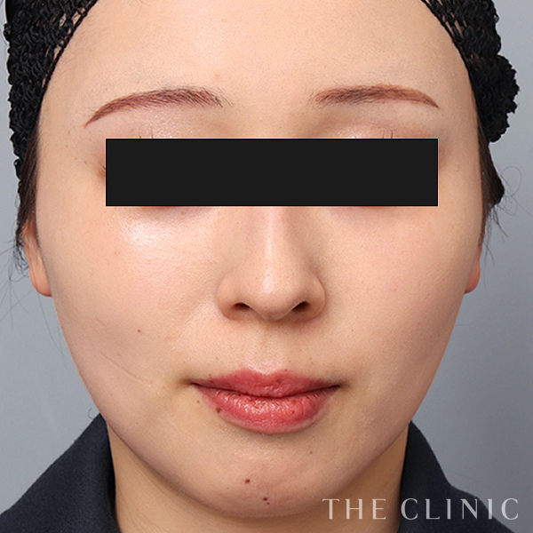 頰／顎のベイザー脂肪吸引（25歳女性）の術後写真
