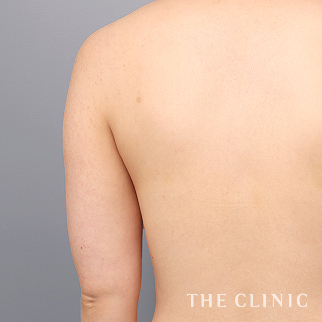 【THE CLINIC 症例画像】No.1479_1_二の腕_ベイザー脂肪吸引(執刀医：志田 雅明)