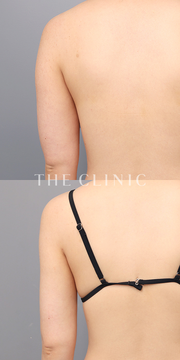 二の腕のベイザー脂肪吸引（25歳女性）の術前・術後写真