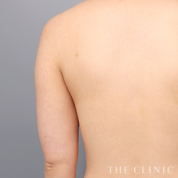 二の腕のベイザー脂肪吸引（25歳女性）の術前写真