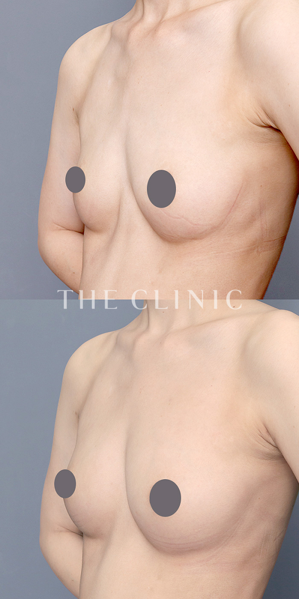 ボリュームアップのエクソソーム豊胸（31歳女性）の術前・術後写真