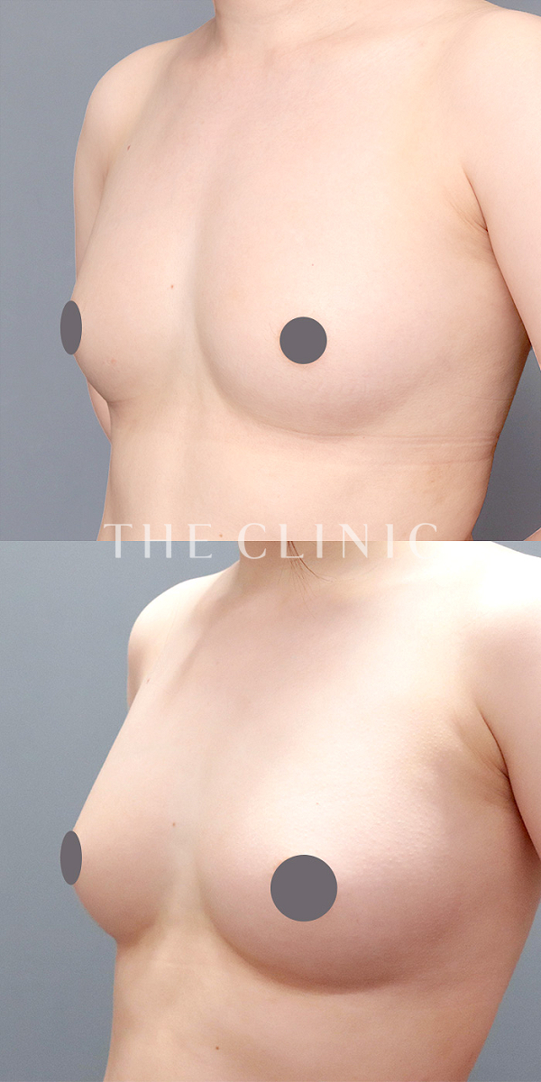 ボリュームアップのコンデンスリッチ豊胸（27歳女性）の術前・術後写真